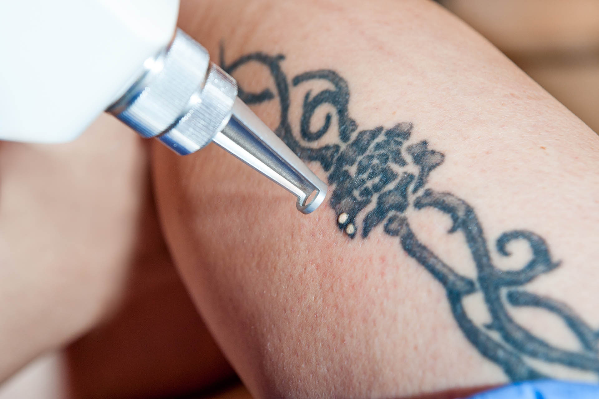 VTCT (ITEC) Level 5 Certificate in Laser Tattoo Removal
